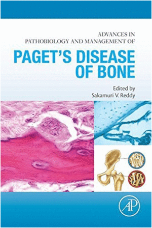 ADVANCES IN PATHOBIOLOGY AND MANAGEMENT OF PAGET�S DISEASE OF BONE