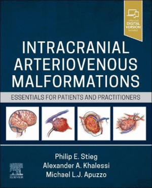 INTRACRANIAL ARTERIOVENOUS MALFORMATIONS. ESSENTIALS FOR PATIENTS AND PRACTITIONERS