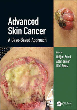 ADVANCED SKIN CANCER. A CASE-BASED APPROACH