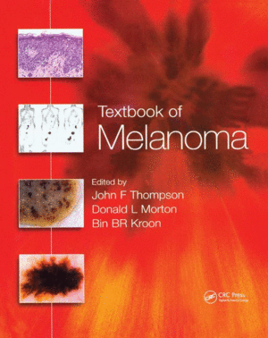 TEXTBOOK OF MELANOMA. PATHOLOGY, DIAGNOSIS AND MANAGEMENT. (PAPERBACK)