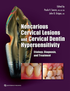 NONCARIOUS CERVICAL LESIONS AND CERVICAL DENTIN HYPERSENSITIVITY. ETIOLOGY, DIAGNOSIS, AND TREATMENT