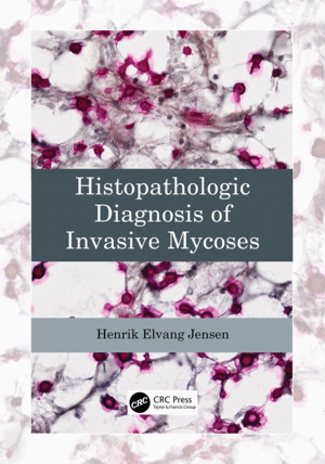 HISTOPATHOLOGIC DIAGNOSIS OF INVASIVE MYCOSES