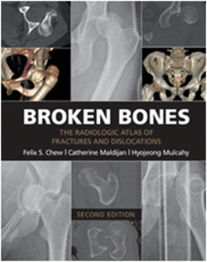 BROKEN BONES. THE RADIOLOGIC ATLAS OF FRACTURES AND DISLOCATIONS. 2ND EDITION