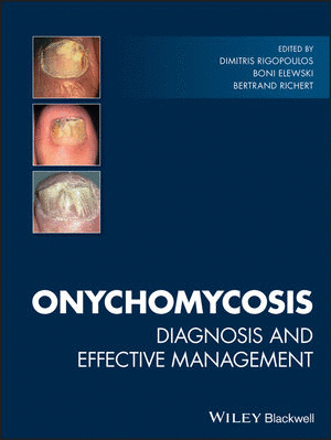 ONYCHOMYCOSIS. DIAGNOSIS AND EFFECTIVE MANAGEMENT