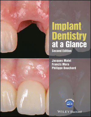 IMPLANT DENTISTRY AT A GLANCE. 2ND EDITION