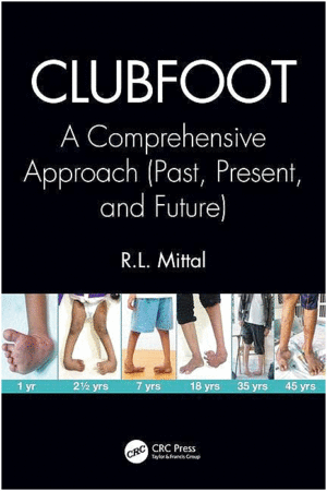 CLUBFOOT. A COMPREHENSIVE APPROACH