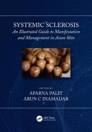 SYSTEMIC SCLEROSIS. AN ILLUSTRATED GUIDE TO MANIFESTATION AND MANAGEMENT IN ASIAN SKIN