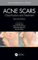 ACNE SCARS. CLASSIFICATION AND TREATMENT. 2ND EDITION