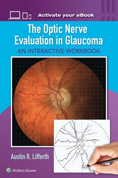 THE OPTIC NERVE EVALUATION IN GLAUCOMA , AN INTERACTIVE WORKBOOK