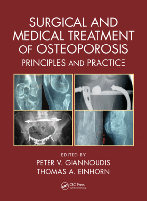 SURGICAL AND MEDICAL TREATMENT OF OSTEOPOROSIS. PRINCIPLES AND PRACTICE