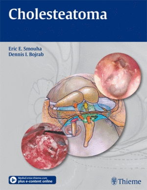 CHOLESTEATOMA + ONLINE ACCESS