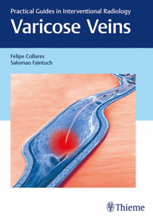 VARICOSE VEINS. PRACTICAL GUIDES IN INTERVENTIONAL RADIOLOGY