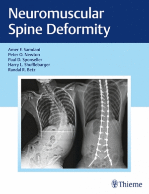 NEUROMUSCULAR SPINE DEFORMITY. A HARMS STUDY GROUP TREATMENT GUIDE