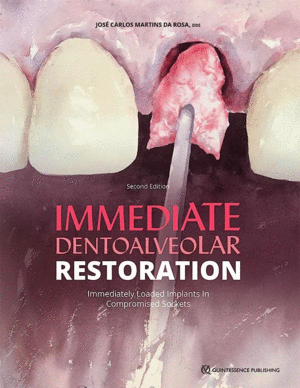 IMMEDIATE DENTOALVEOLAR RESTORATION. IMMEDIATELY LOADED IMPLANTS IN COMPROMISED SOCKETS. 2ND EDITION