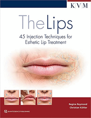 THE LIPS. 45 INJECTION TECHNIQUES FOR ESTHETIC LIP TREATMENT