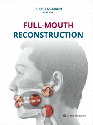 FULL-MOUTH RECONSTRUCTION
