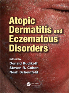 ATOPIC DERMATITIS AND ECZEMATOUS DISORDERS