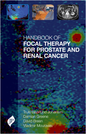 HANDBOOK OF FOCAL THERAPY FOR PROSTATE AND RENAL CANCER