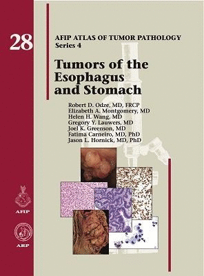 TUMORS OF THE ESOPHAGUS AND STOMACH. AFIP ATLAS OF TUMOR PATHOLOGY SERIES 4