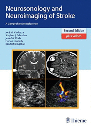 NEUROSONOLOGY AND NEUROIMAGING OF STROKE: A COMPREHENSIVE REFERENCE + VIDEOS. 2ND EDITION