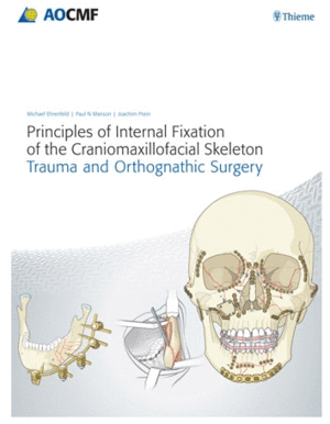 PRINCIPLES OF INTERNAL FIXATION OF THE CRANIOMAXILLOFACIAL SKELETON