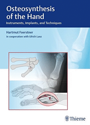OSTEOSYNTHESIS OF THE HAND: INSTRUMENTS, IMPLANTS, AND TECHNIQUES