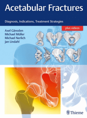 ACETABULAR FRACTURES. DIAGNOSIS, INDICATIONS, TREATMENT STRATEGIES