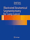 ILLUSTRATED ANATOMICAL SEGMENTECTOMY FOR LUNG CANCER