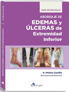 ABORDAJE DE  EDEMAS Y LCERAS DE EXTREMIDAD INFERIOR