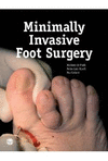 MINIMAL INVASIVE SURGERY OF FOOT AND ANKLE