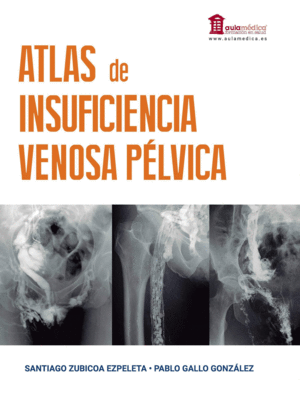 ATLAS DE INSUFICIENCIA VENOSA P�LVICA