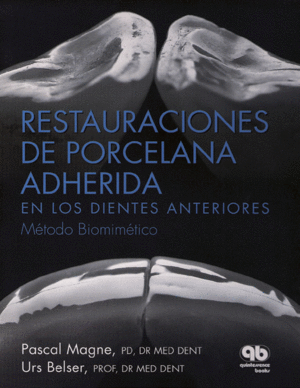 RESTAURACIONES DE PORCELANA ADHERIDA EN LOS DIENTES ANTERIORES: MTODO BIOMIMTICO