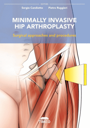 MINIMALLY INVASIVE HIP ARTHROPLASTY. SURGICAL APPROACHES AND PROCEDURES