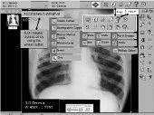 ILO INT. CLASSIFICATION OF RADIOGRAPHS OF PNEUMOCONIOSES