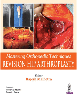 MASTERING ORTHOPEDIC TECHNIQUES: REVISION TOTAL HIP ARTHROPLASTY