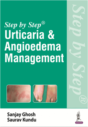 STEP BY STEP URTICARIA AND ANGIOEDEMA MANAGEMENT
