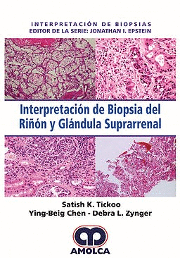 INTERPRETACIN DE BIOPSIA DEL RIN Y GLNDULA SUPRARRENAL (INTERPRETACIN DE BIOPSIAS)