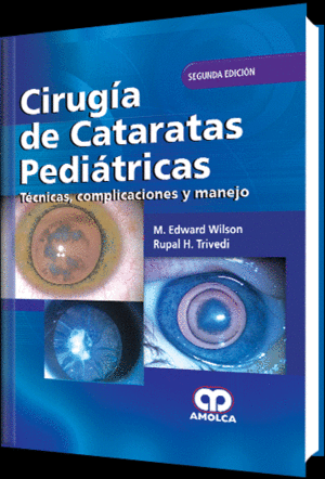CIRUGIA DE CATARATAS PEDIATRICAS. TECNICAS, COMPLICACIONES Y MANEJO. 2 EDICIN