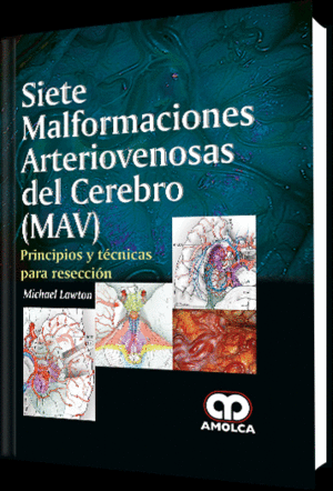 SIETE MALFORMACIONES ARTERIOVENOSAS DEL CEREBRO (MAV). PRINCIPIOS Y TECNICAS PARA RESECCION