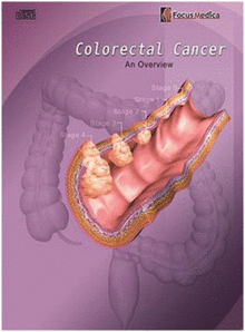 COLORECTAL CANCER. CD-ROM