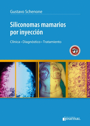 SILICONOMAS MAMARIOS POR INYECCION. CLINICA, DIAGNOSTICO, TRATAMIENTO