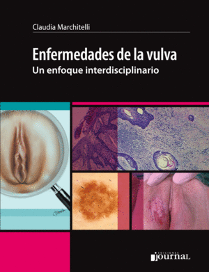 ENFERMEDADES DE LA VULVA. UN ENFOQUE INTERDISCIPLINARIO