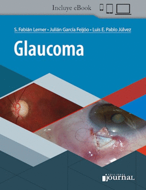 GLAUCOMA (INCLUYE E-BOOK)