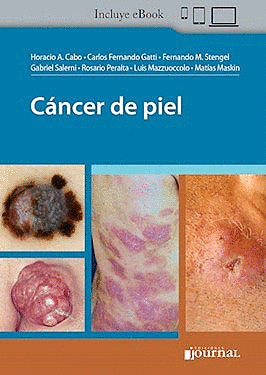 CÁNCER DE PIEL (INCLUYE E-BOOK)